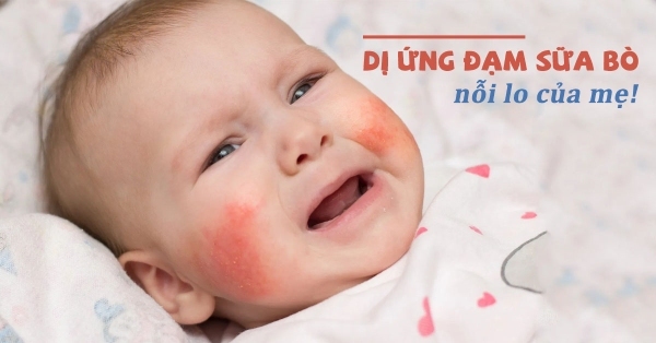 ​  Trẻ dị ứng đạm sữa bò